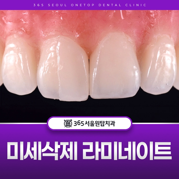 미세삭제 라미네이트