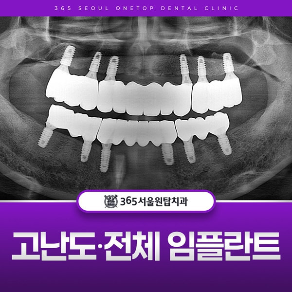 고난도,전체 임플란트